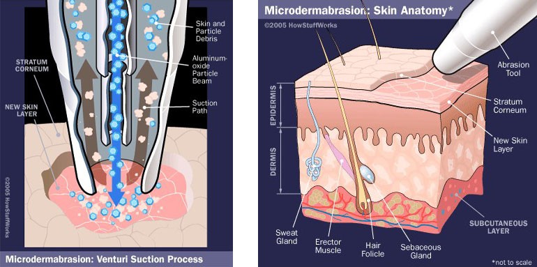 Microdermabrasion facial Fort Myers